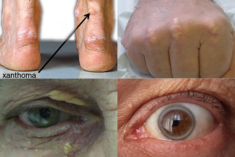 Familiáris hiperkoleszterinémia - Életet menthet a korai felismerés